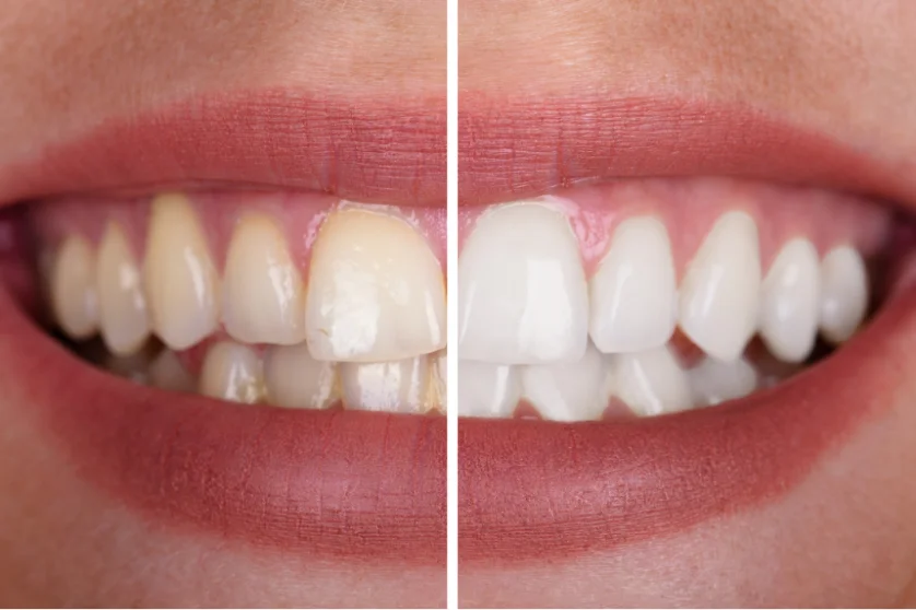 Estética dental